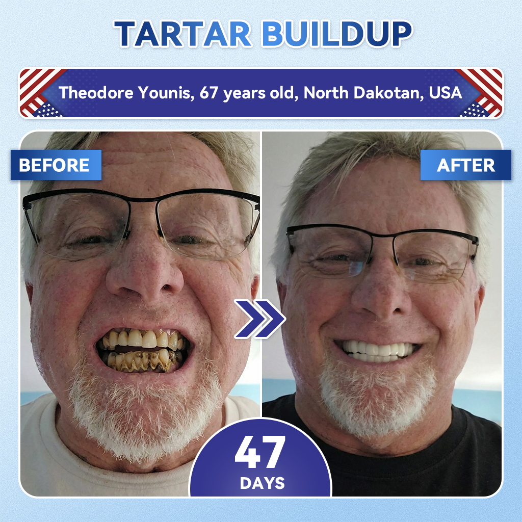 🔥LAST DAY SALE 49% OFF--OnlyJoy™ 🦷 Tideglusib Fast‑Dissolving Tooth & Gum Repair Oral Strips ✨
