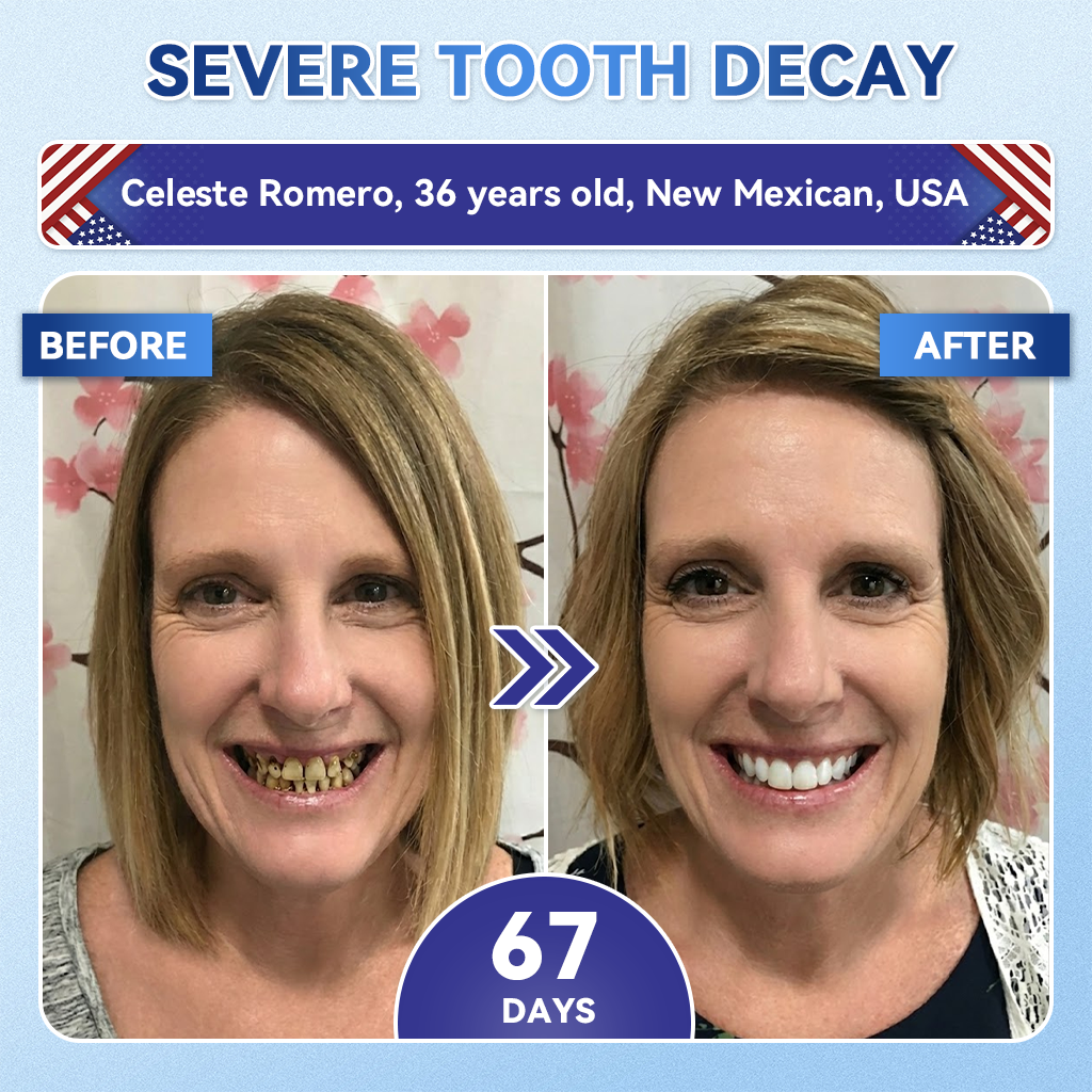 🔥LAST DAY SALE 49% OFF--OnlyJoy™ 🦷 Tideglusib Fast‑Dissolving Tooth & Gum Repair Oral Strips ✨
