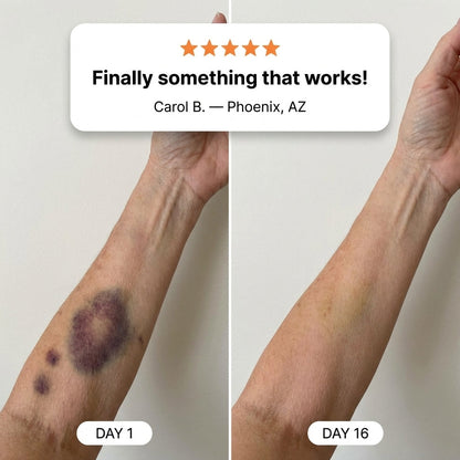💥100K+ SOLD💕- ONLYJOY® Bruise Repair & Skin-Strengthening Cream